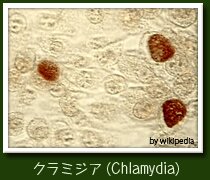 性器クラミジア感染症　写真画像